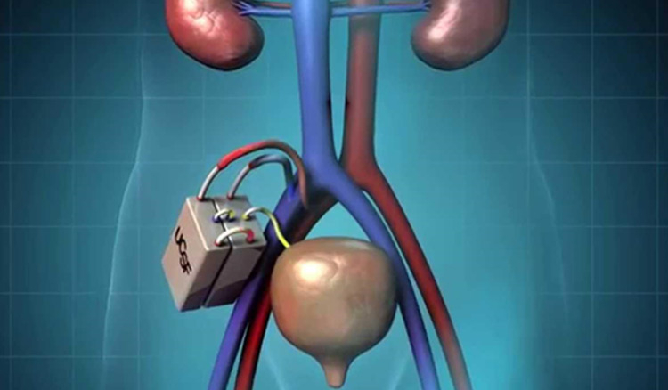 First artificial implantable kidney developed